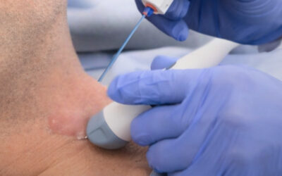 ¿Dónde hacerse la radiofrecuencia de nódulos tiroideos sin cirugía?